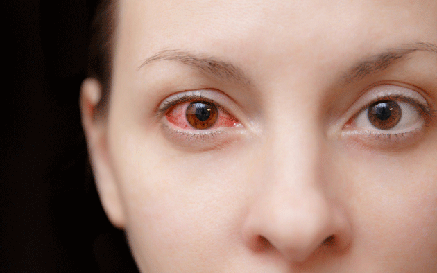 اعراض التهاب العين