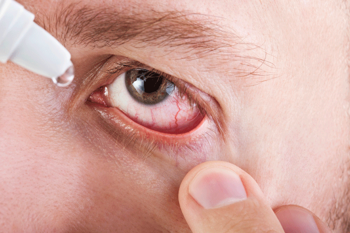 اعراض التهاب العين