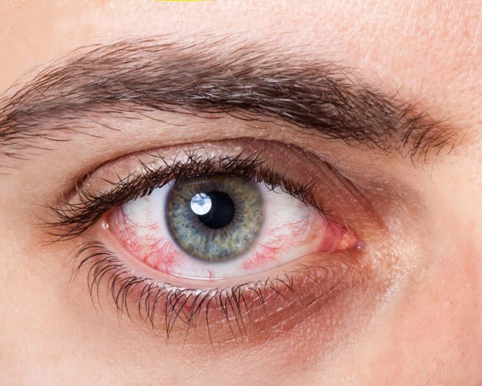 متلازمة جفاف العين