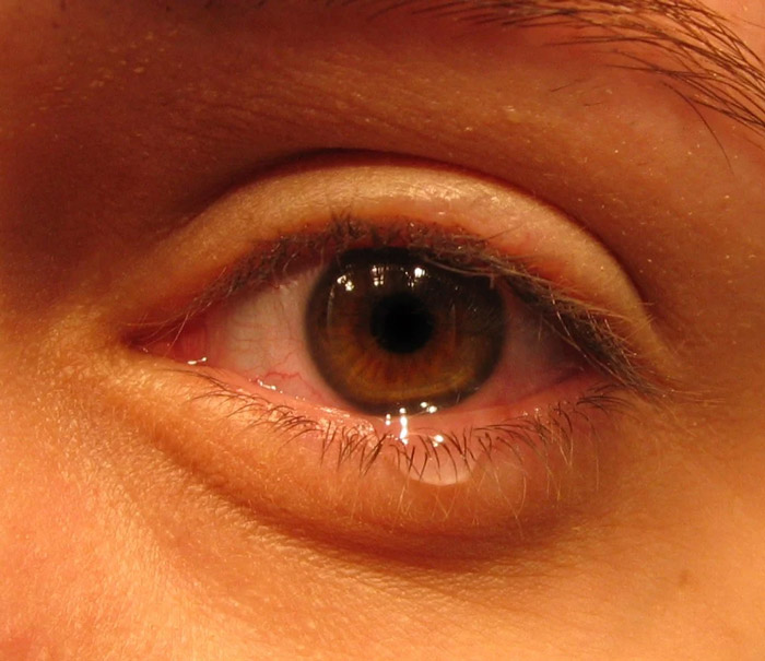 حساسية العين والعيون الدامعة