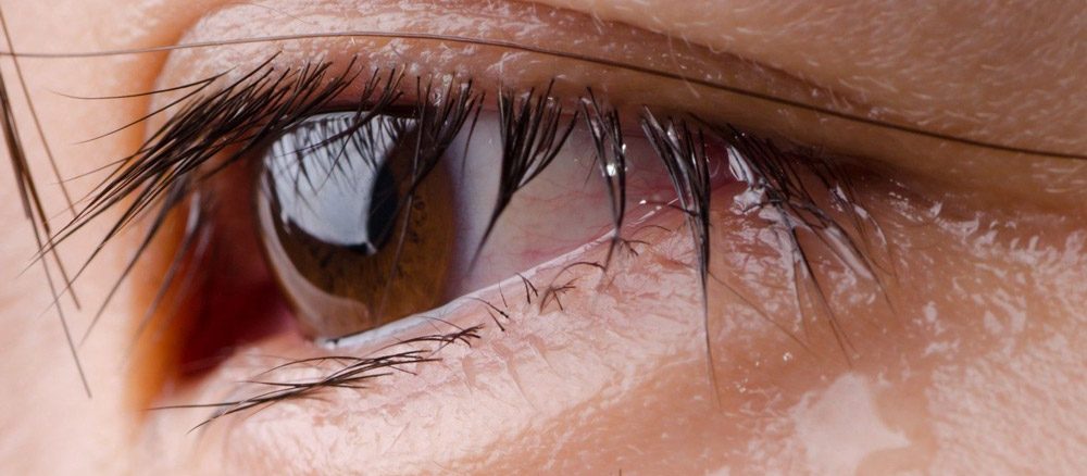 حساسية العين والعيون الدامعة