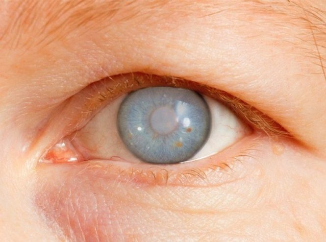 اعراض وجود مياه بيضاء في العين