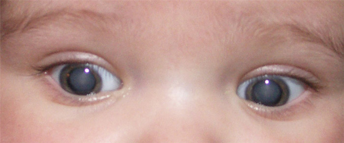 اعراض وجود مياه بيضاء في العين