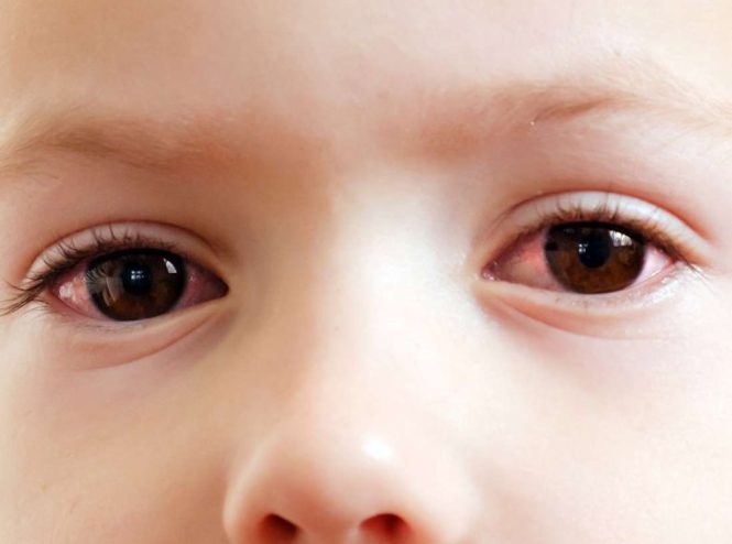 سبب احمرار العين عند الاطفال
